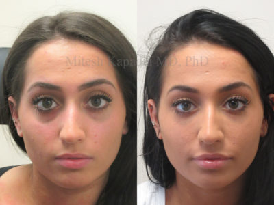 Woman in her mid-20s before and after lower eyelid and midface fillers, displaying reduced dark circles and a smoother eyelid to cheek junction