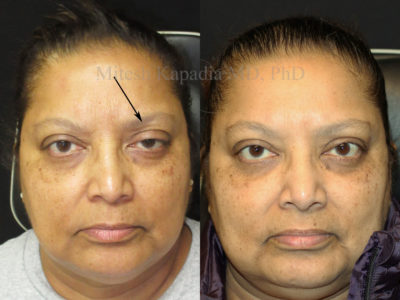 Woman in her early 60s before and after ptosis repair surgery, giving her a more symmetric and balanced appearance
