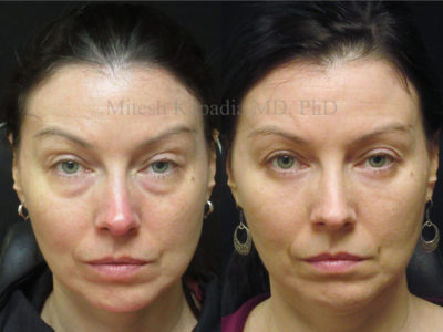 Woman in her mid-30s before and after lower eyelid surgery, revealing reduced undereye bags, giving her a refreshed, less tired appearance