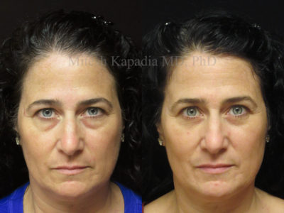 Woman in her late 40s before and after lower eyelid surgery, showing reduced undereye bags, giving her a more youthful, well rested look