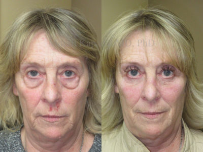 Woman in her mid-50s before and after lower eyelid surgery with undereye filler injections done after her procedure, showing a smoother, rejuvenated and more youthful appearance