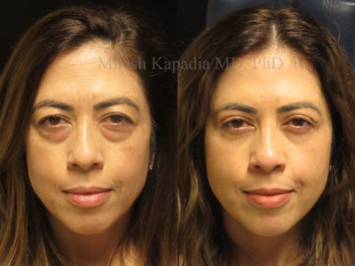 Woman in her mid-40s before and after upper and lower eyelid surgery, revealing less puffiness under the eyes, giving her a refreshed, well rested appearance