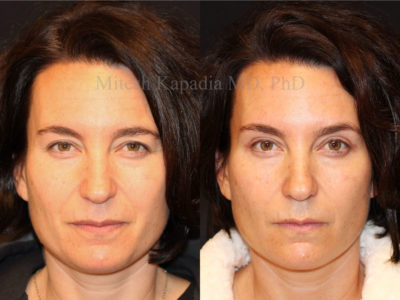Woman in her early 40s before and after upper eyelid surgery, revealing a well rested, natural appearance