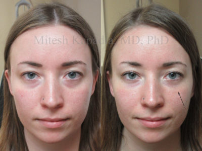 Woman in her 20s before and after lower eyelid fillers to address her concern of dark circles. After her procedure, she looks less tired and rejuvenated