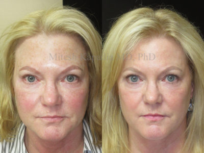 Woman in her early 60s before and after full face skin resurfacing with a fractional CO2 laser, showing a reduction in redness and pigmentation