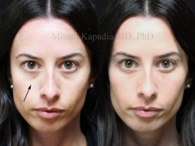 Woman in her early 30s before and after lower eyelid filler injections, revealing decreased dark circles and displaying a less tired and refreshed look