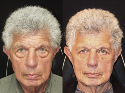 Man in his mid-70s before and after lower eyelid surgery, showing greatly reduced under eye bags, leaving him looking well rested and refreshed