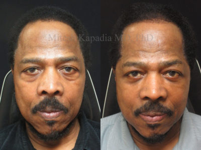 Man that is 70 years old is shown before and after lower eyelid surgery, leaving him looking naturally youthful and refreshed