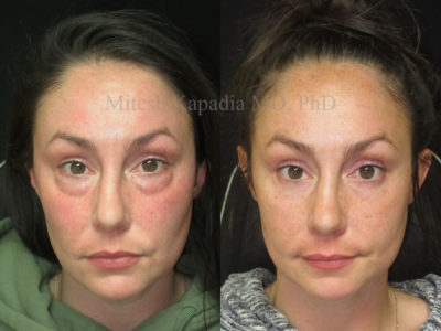 Woman in her early 30s before and after lower eyelid surgery, revealing a rejuvenated look