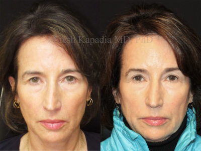 Woman in her mid-60s before and after upper eyelid surgery, revealing the appearance of more opened eyes and a refreshed look