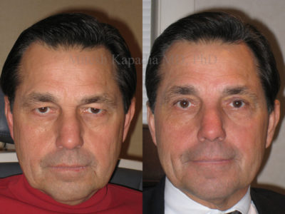 Man is his 60s displayed to show a refreshed appearance after upper eyelid surgery