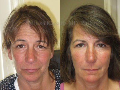Woman in her early 50s before and after upper eyelid surgery, also with lower eyelid fillers to create a smooth, symmetrical and more youthful look