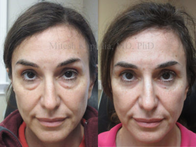 Woman in her late 40s after lower eyelid surgery, appearing refreshed and more awake