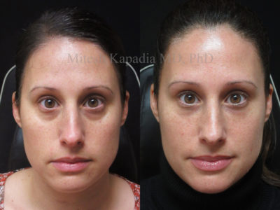 Woman in her 30s before and after lower eyelid and midface fillers, revealing greatly reduced dark circles under the eyes, leaving her with a well rested, vibrant look