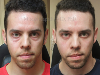 Man in his early 30s before and after lower eyelid surgery, revealing diminished undereye bags, giving him a well rested and refreshed appearance