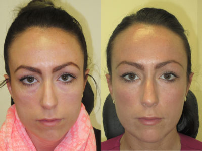 Woman in her late 20s before and after lower eyelid, midface and cheek fillers, leaving her with a smoother, softer, and refreshed appearance