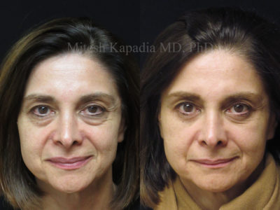 Woman in her late 50s before and after lower eyelid surgery, revealing a refreshed, more youthful, and smoother appearance