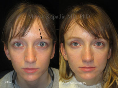 Woman in her 20s before and after upper eyelid correction of eyelid retraction. This gave her a more symmetrical and even look