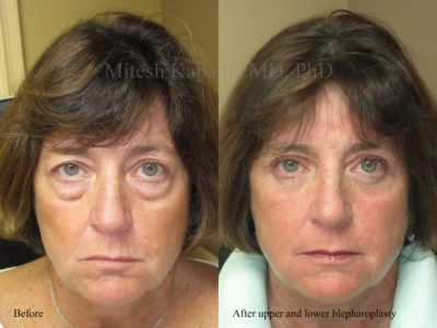 Woman in her early 60s before and after upper and lower eyelid surgery, displaying a more youthful, smooth, and well rested appearance