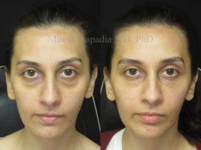 Woman in her early 30s before and after lower eyelid fillers, revealing a refreshed and less tired appearance