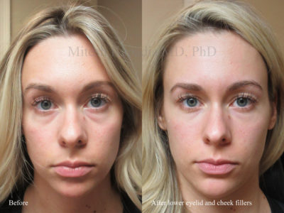 Woman in her 20s before and after lower eyelid, midface, and cheek fillers. After this procedure, she appears well rested, smooth, and vibrant
