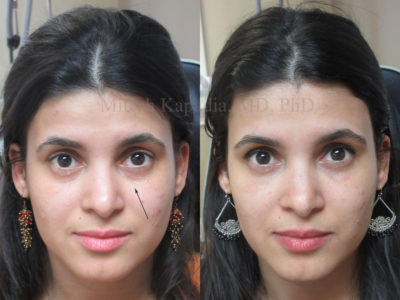 Woman in her 20s before and after lower eyelid filler injections, displaying diminished dark undereye circles, giving her a well rested and refreshed appearance