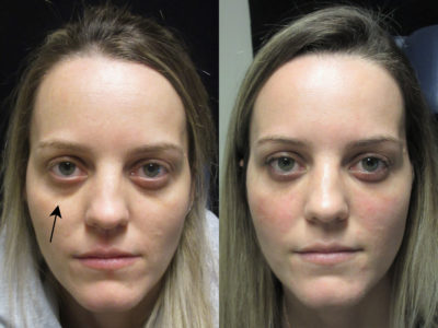 Woman in her 20s before and after lower eyelid and midface fillers, reducing the appearance of undereye shadowing, giving her a less tired and refreshed look