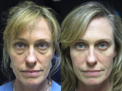 Woman in her late 40s appears reinvigorated after upper and lower eyelid surgery