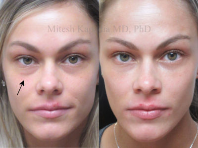 Woman in her 20s before and after lower eyelid filler injections, providing a smoother transition from lower eyelid to cheek and alleviating dark circles