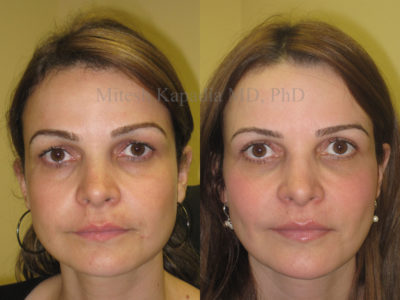 Woman in her late 30s before and after upper eyelid surgery, as well as lower eyelid filler injections. These procedures gave her a less tired, refreshed look while still appearing natural
