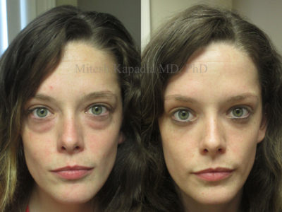 Young woman in her mid-20s after lower eyelid surgery displaying a reinvigorated appearance
