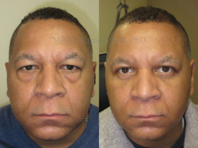 Man in his mid-50s before and after upper and lower eyelid surgery, displaying a vibrant, refreshed appearance