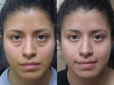 Woman in her late 20s before and after lower eyelid surgery and lower eyelid fillers, displaying a smooth, refreshed appearance