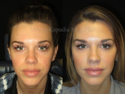 Woman in her late 20s before and after lower eyelid, midface, and cheek fillers, producing a smoother, healthier, and well rested appearance