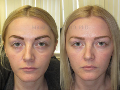 Woman in her 20s before and after lower eyelid and midface fillers, decreasing the appearance of undereye bags and hollowing, leaving her with a soft, well rested look