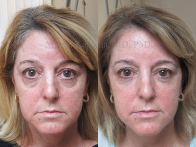 Woman in her late 50s before and after lower eyelid and midface fillers, creating a smoother, less tired appearance