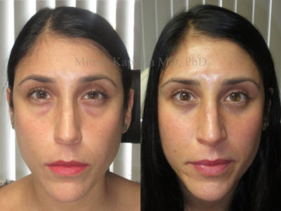 Woman in her mid-30s before and after lower eyelid surgery, displaying a natural, refreshed and less tired look