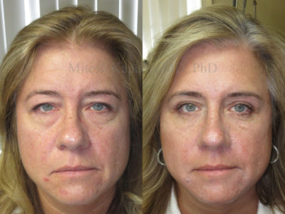 Woman in her late 40s before and after upper and lower eyelid surgery, giving her a more youthful, less tired look