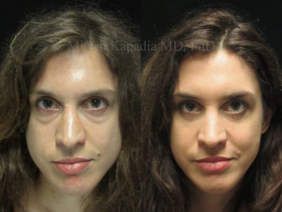 Woman in her 30s before and after lower eyelid surgery with jaw slimming Botox injections. She is shown after her procedure with diminished undereye bags, revealing a well rested and less tired look, while her jaw, after the Botox injections, appears smaller and more feminine, giving her a softer appearance