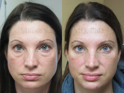Woman in her late 30s before and after lower eyelid surgery, showing greatly reduced undereye puffiness, giving her a less tried, rejuvenated look