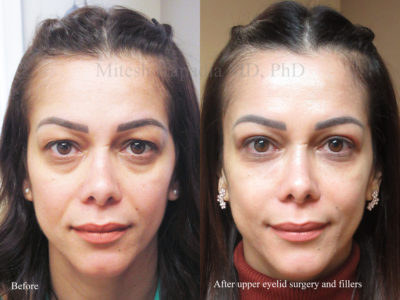 Woman in her 40s before and after upper eyelid surgery and lower eyelid filler injections, revealing a more youthful and less tired appearance