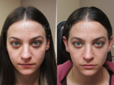 Woman in her mid-20s before and after filler injections to her lower eyelid, chin, and lips, leaving her with a soft, well rested and natural appearance