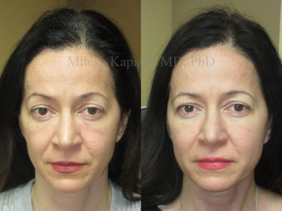 Woman in her late 40s before and after lower eyelid, midface, and cheek fillers, leaving her with a smoother, more youthful appearance