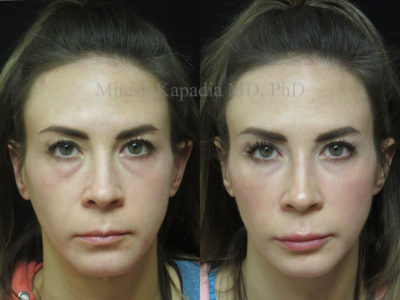 Woman in her late 30s before and after lower eyelid and cheek filler injections, which camouflaged her undereye bags, giving her a refreshed, less tired look while still looking natural