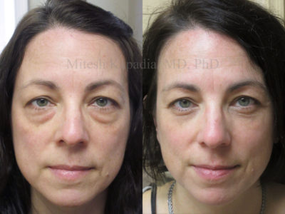 Woman in her 40s before and after lower eyelid surgery, revealing diminished undereye bags, giving her a well rested and refreshed look