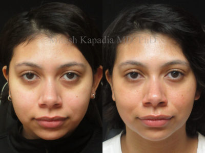 Woman in her 20s before and after lower eyelid filler injections, showing lessened dark circles under the eyes, giving her a refreshed and less tired appearance