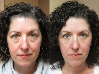 Woman in her mid-40s before and after lower eyelid surgery, with lower eyelid filler injections done after her procedure, displaying a more youthful, refreshed look