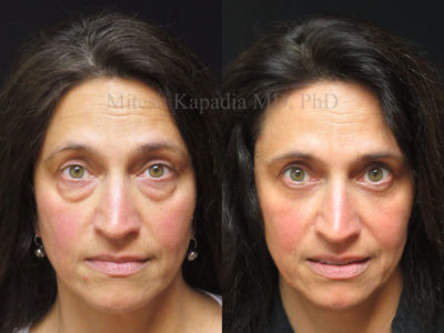 Woman in her late 40s before and after lower eyelid surgery, displaying the greatly reduced appearance of eye bags, leaving her looking younger and well rested