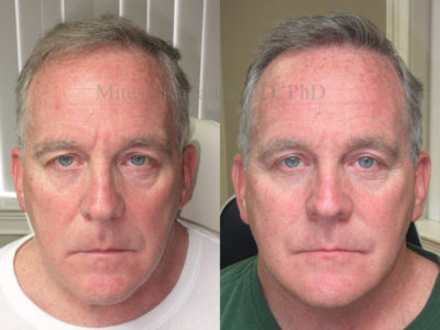 Man in his mid-50s before and after upper eyelid surgery, revealing a more youthful, less tired appearance