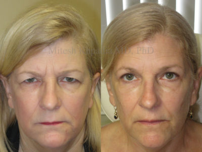Woman in her late 50s before and after upper eyelid surgery and Botox, revealing a softer, youthful and rejuvenated look
